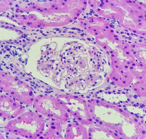 Importance of Hematuria as a Biomarker for IgA Nephropathy