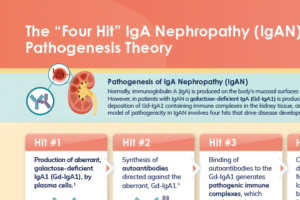 Infographic – The “Four Hit” IgA Nephropathy (IgAN) Pathogenesis Theory